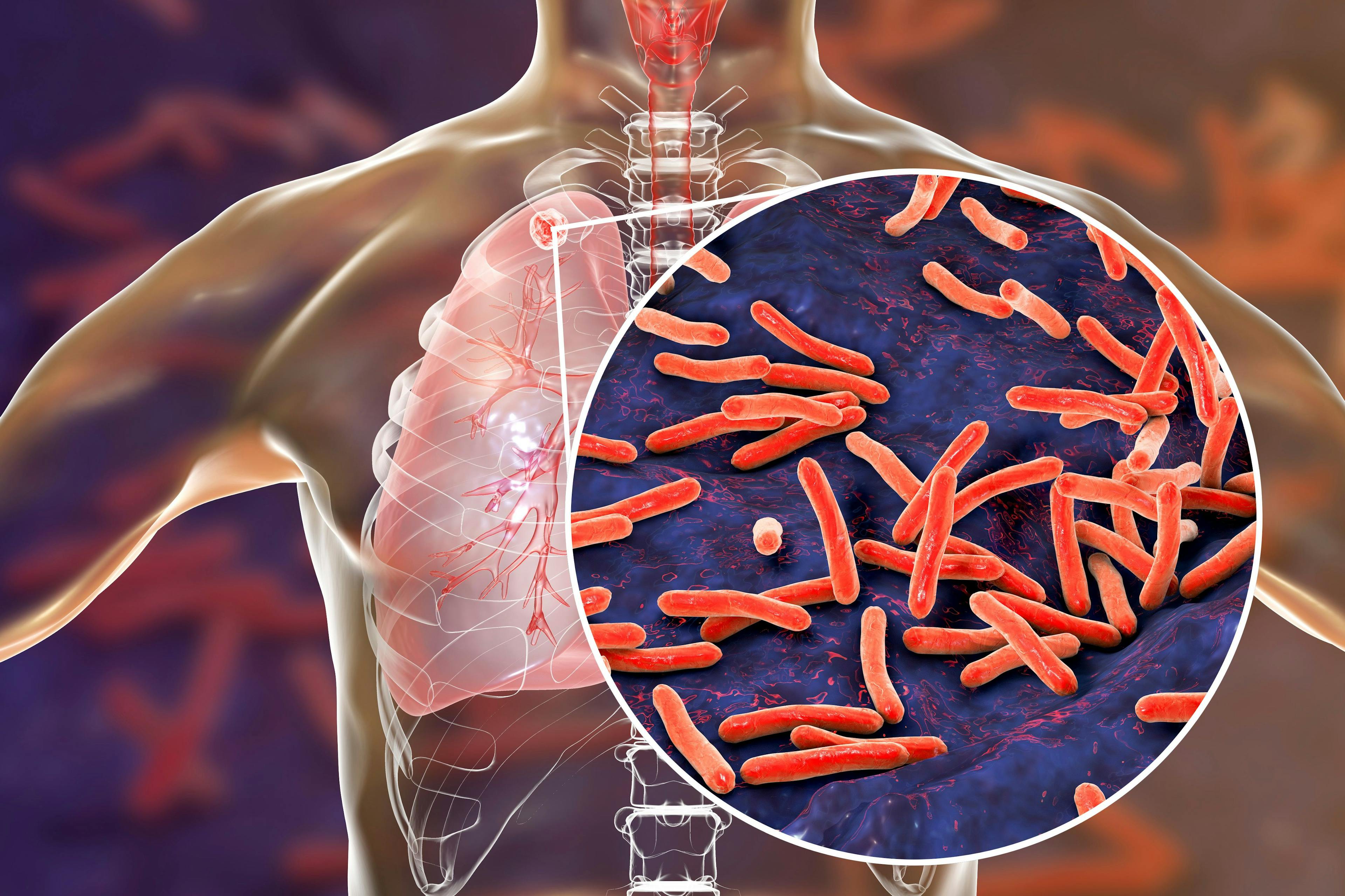 Secondary tuberculosis in lungs and close-up view of Mycobacterium tuberculosis bacteria, 3D illustration | Image Credit: © Dr_Microbe - stock.adobe.com
