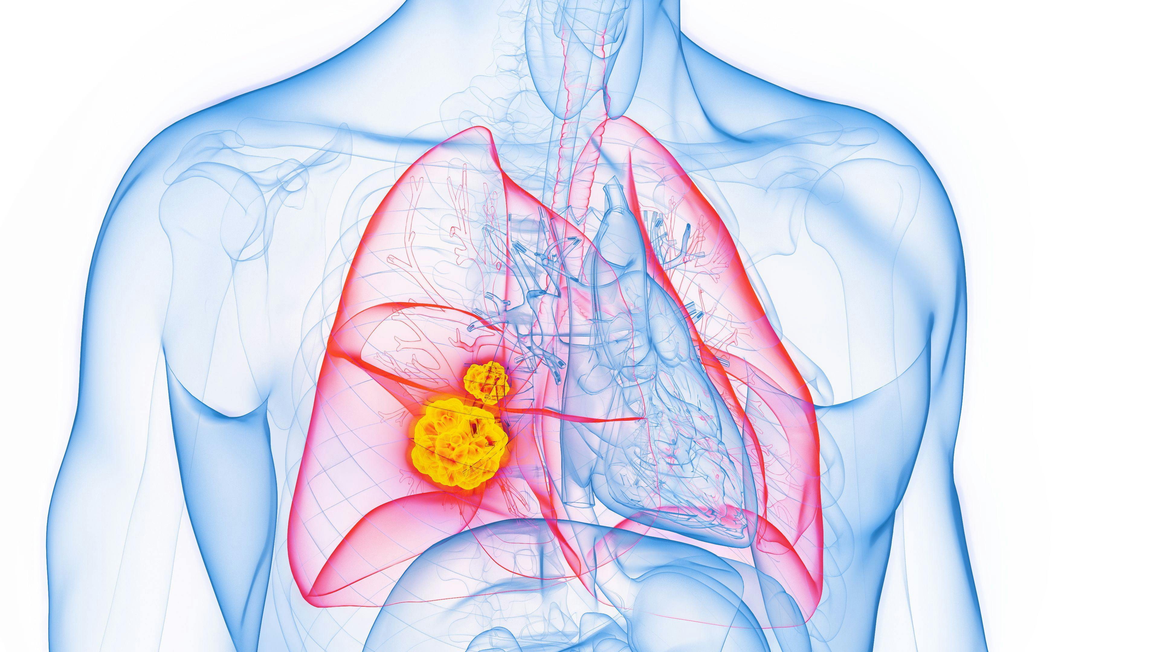 3D rendered Medical Illustration of Male Anatomy - Lung Cancer. | Image Credit: © SciePro - stock.adobe.com