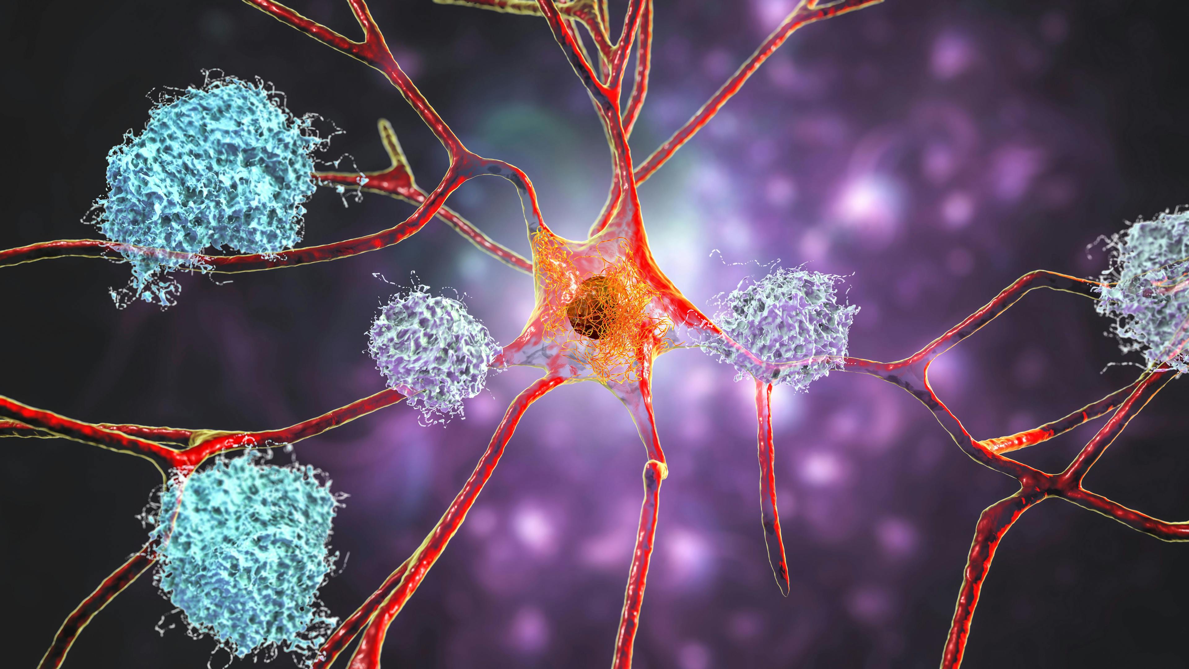 Neurons in Alzheimer's disease. Illustration showing amyloid plaques in brain tissue | Image Credit: © Dr_Microbe - stock.adobe.com