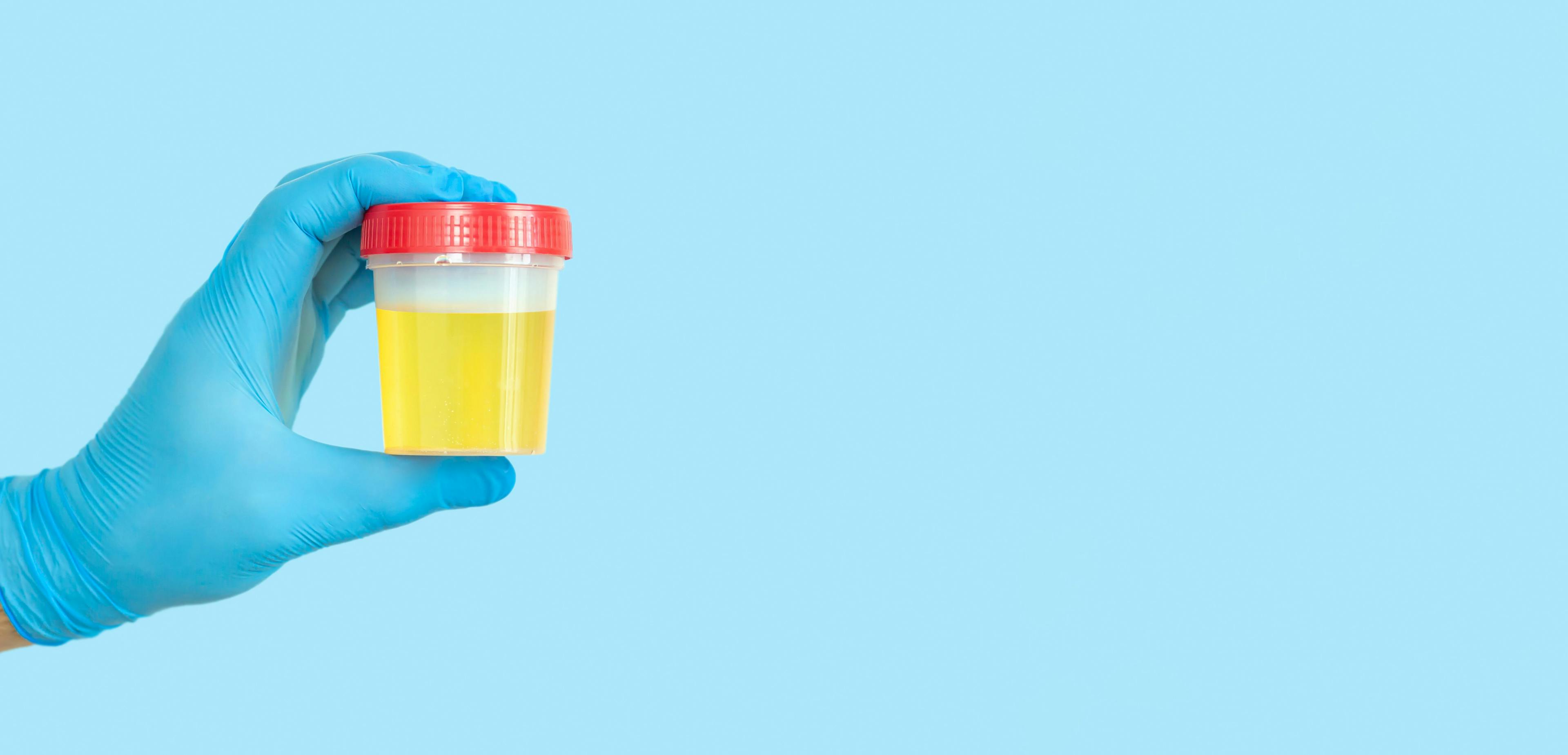 Hand holding urine sample container for medical urinalysis | Image Credit: © Дмитрий Сидор - stock.adobe.com