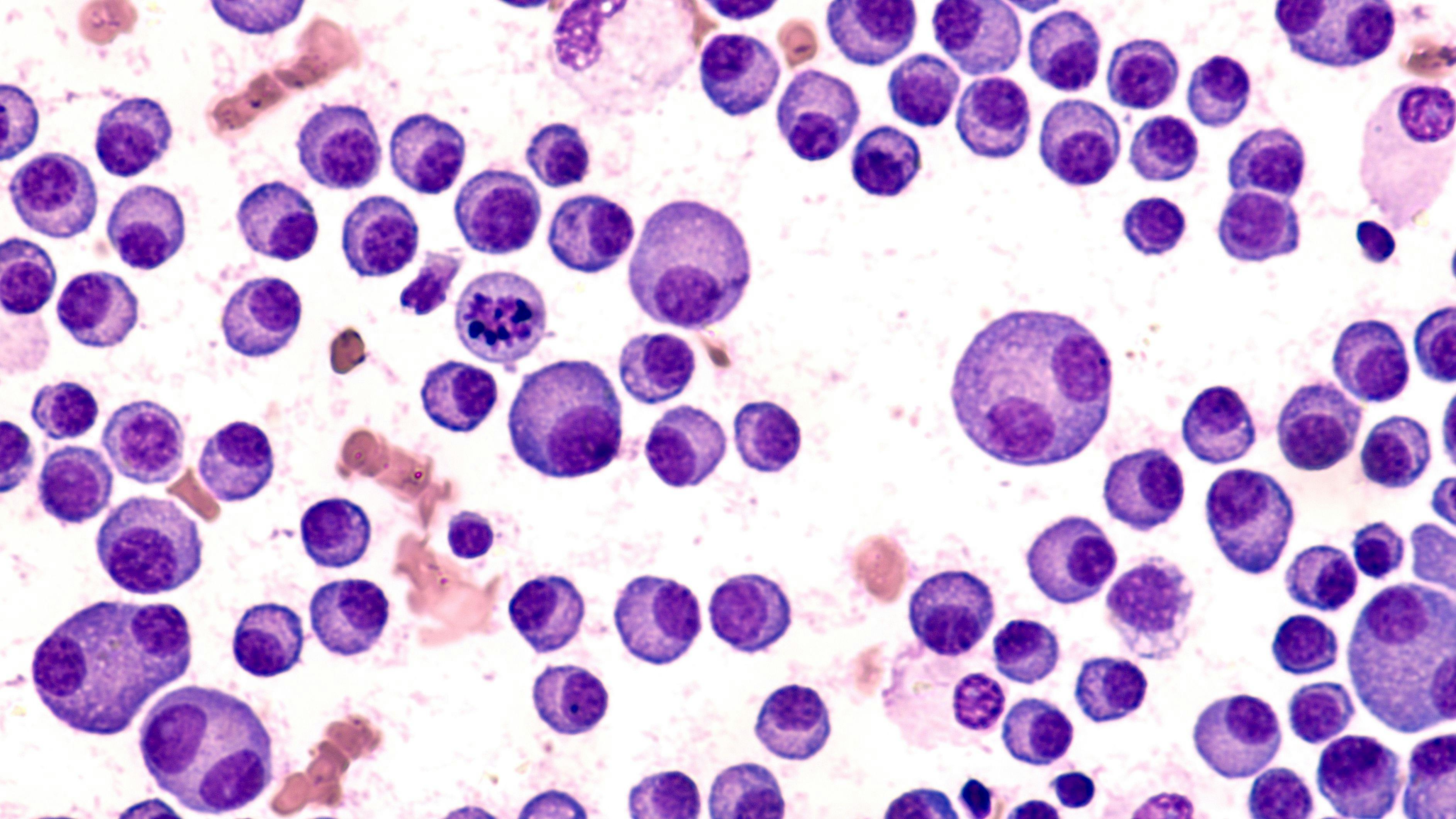Multiple Myeloma Awareness: Bone marrow aspirate cytology of multiple myeloma, a type of bone marrow cancer of malignant plasma cells, associated with bone pain, bone fractures and anemia. | Image Credit: © David A Litman - stock.adobe.com