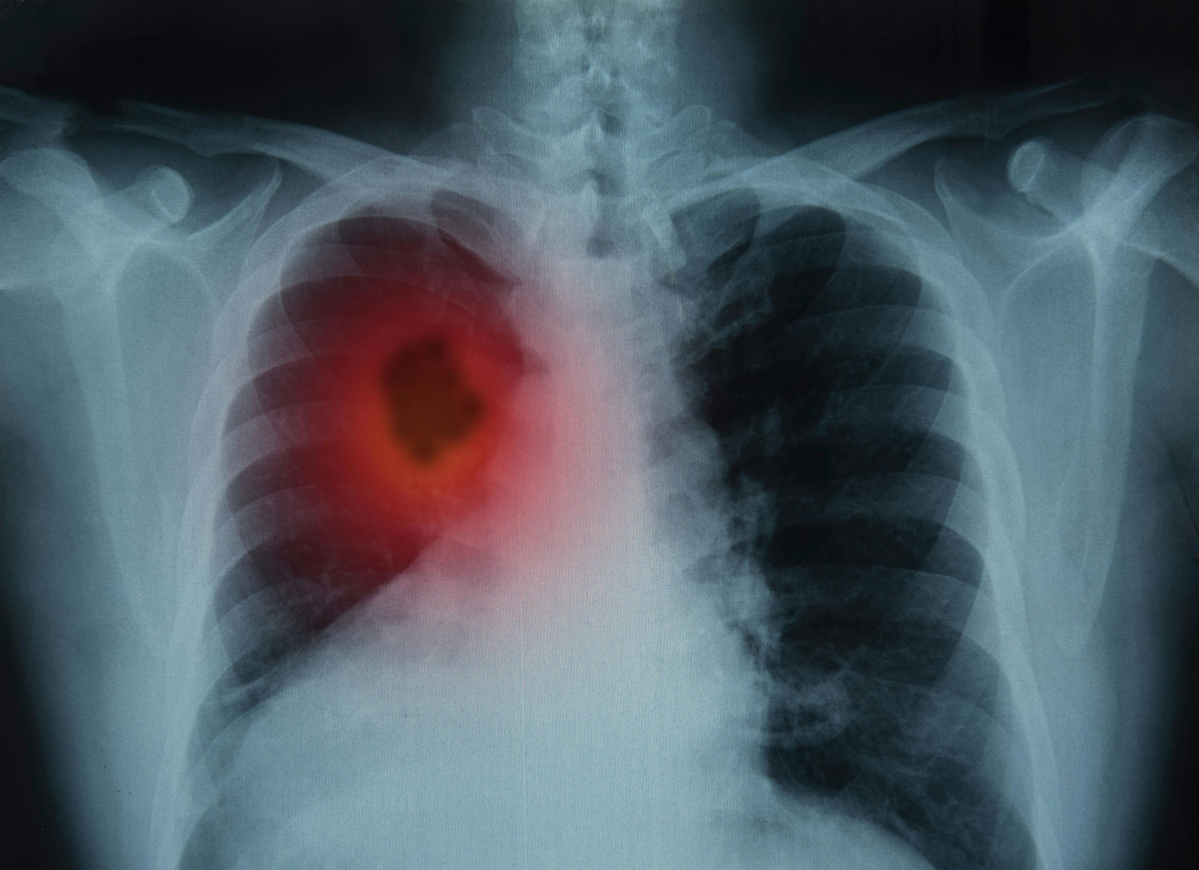 lung cancer | Image Credit: © utah51 - stock.adobe.com