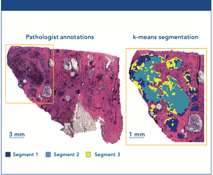Figure 1: The left image shows the H&E stained section with the tumor area marked in blue by a pathologist. The right image is the tumor area zoomed in after segmentation analysis using k-means clustering, which produced three segments representing tumor subpopulations.