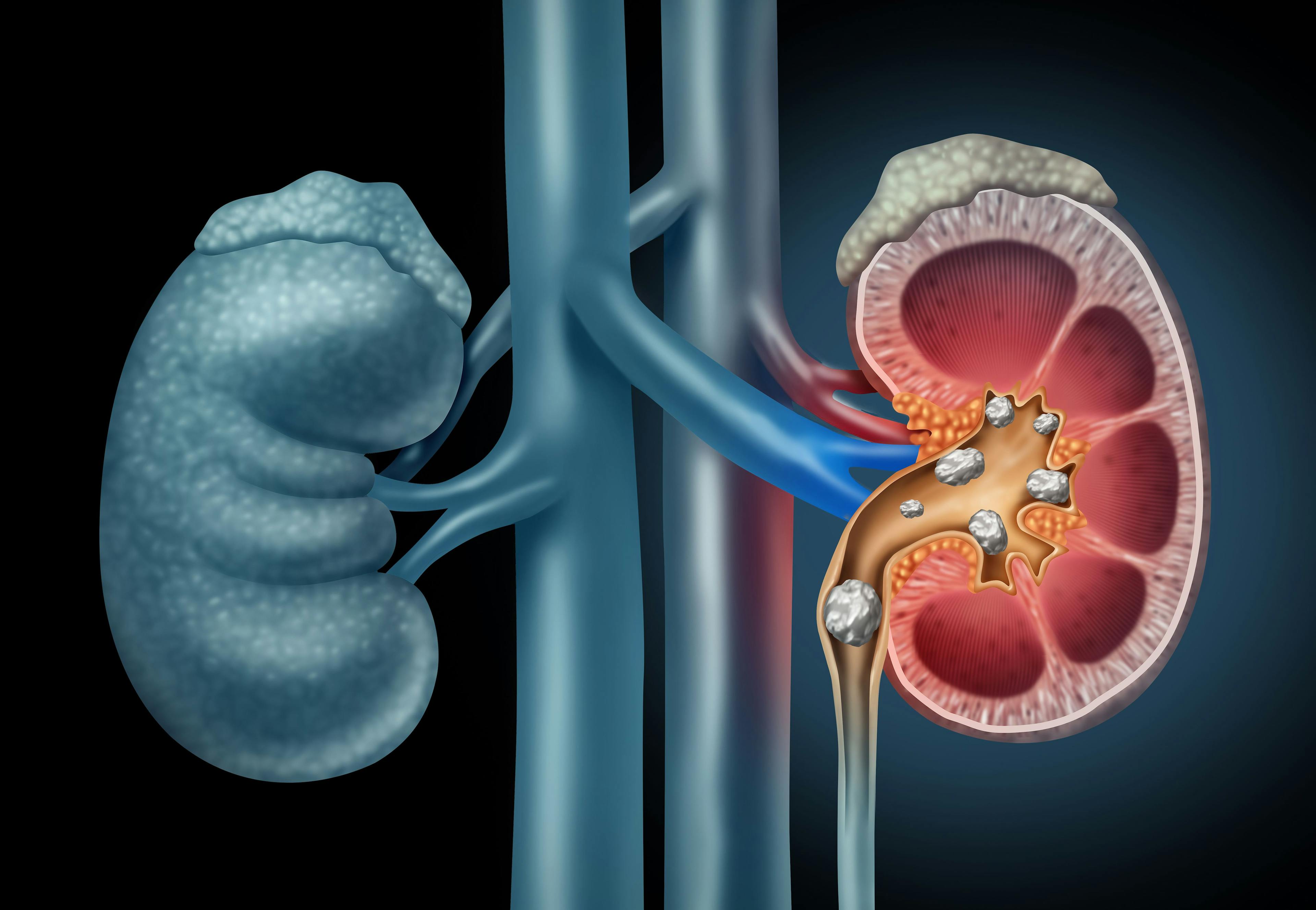 Human kidney Stones Medical Concept | Image Credit: © freshidea - stock.adobe.com