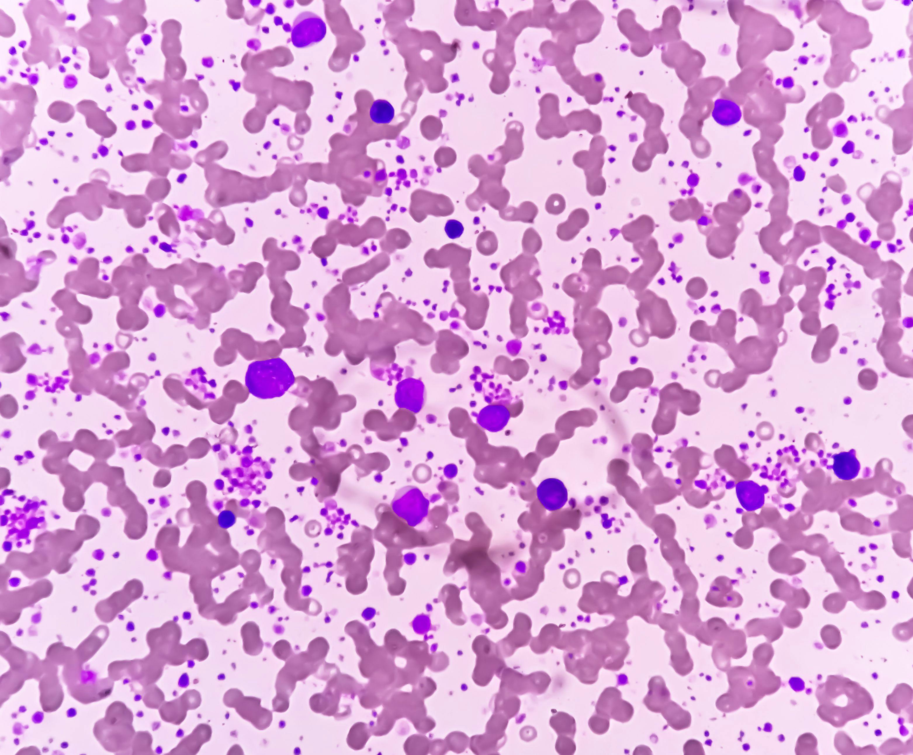Chronic myeloid leukemia (CML) in accelerated phase with thrombocytosis. Chronic myelogenous leukemia. | Image Credit: © Saiful52 - stock.adobe.com