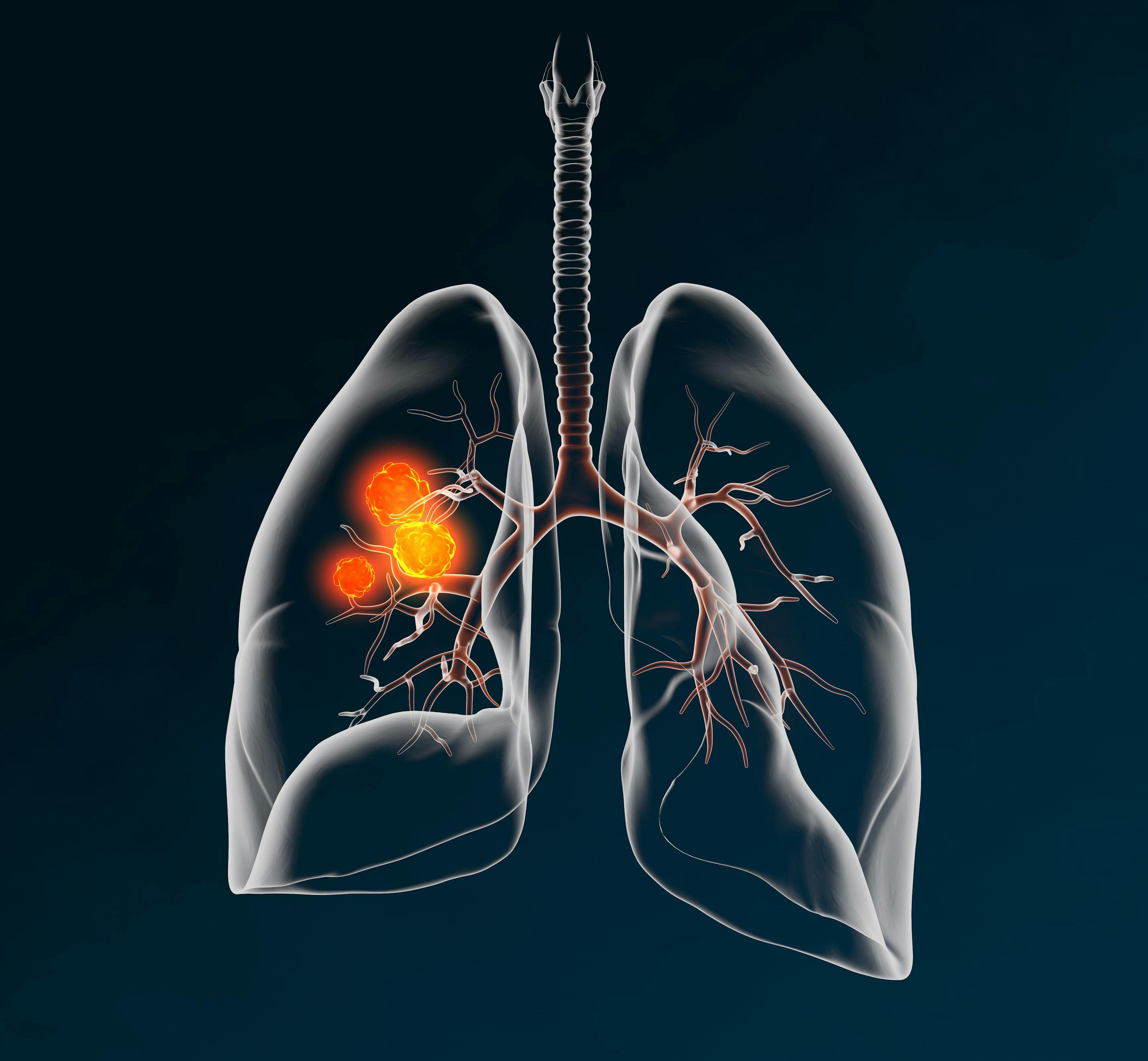 Lung cancer, medically 3D illustration on dark background | Image Credit: © Axel Kock - stock.adobe.com