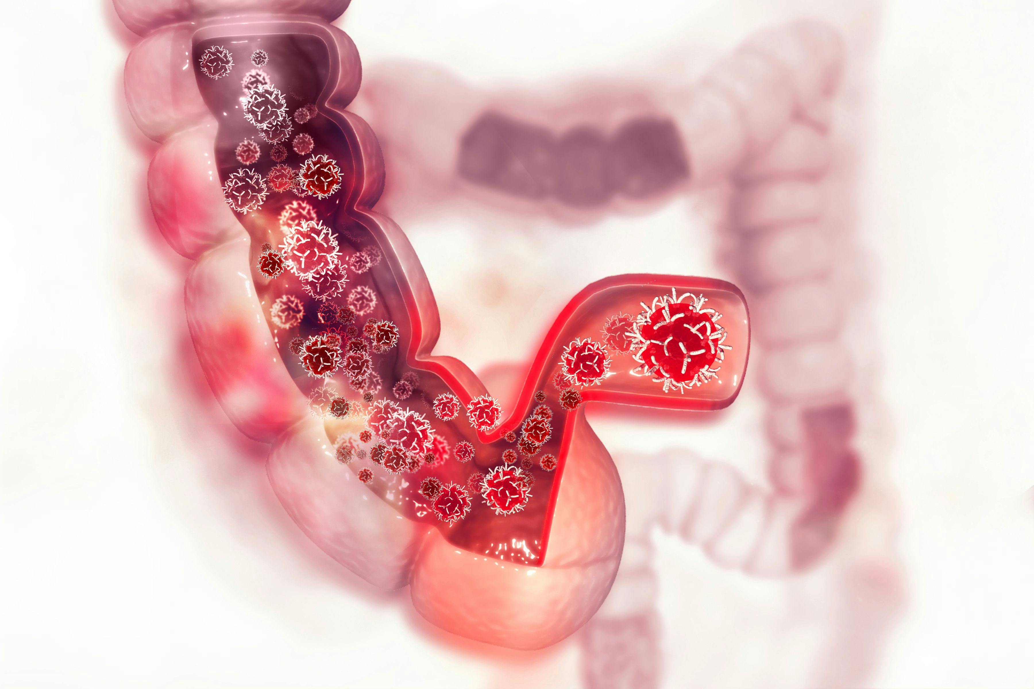 Colon cancer. Cancer attacking cell. Colon disease concept | Image Credit: © Crystal light - stock.adobe.com